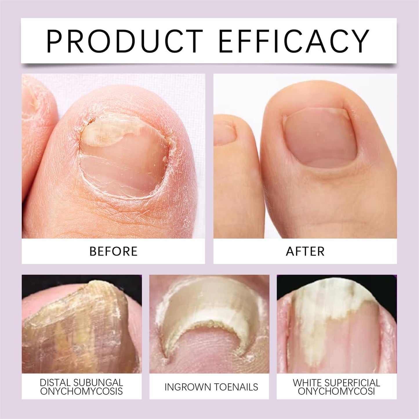 Bee Venom Nail Repair (Buy 1 Get 1 Free)