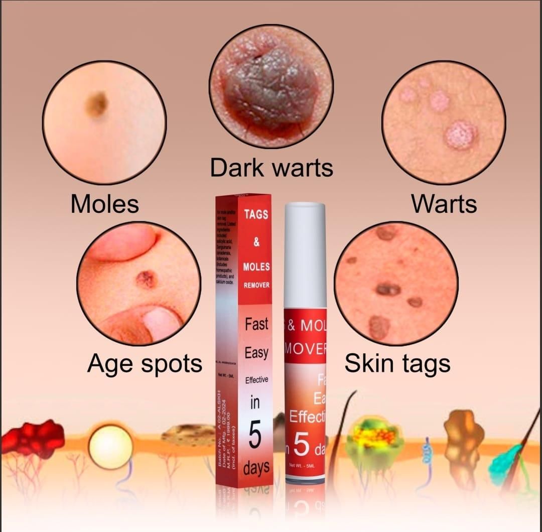 Tags & Moles Remover (Buy 1 Get 1 Free)