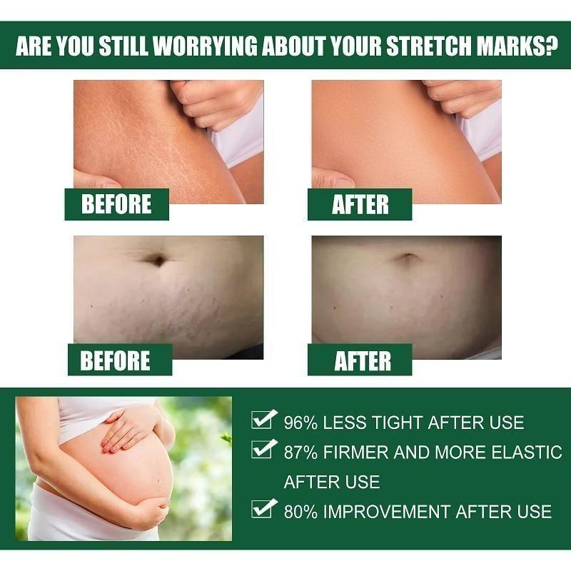 Stretch Marks Removal Cream
