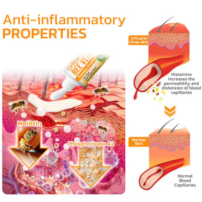 Urticaria Bee Venom Therapy Cream
